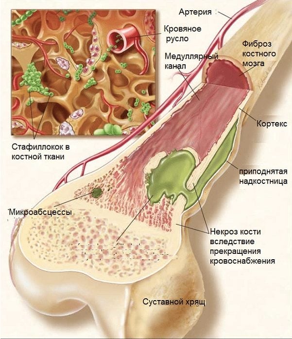 Чем лечить когда болят кости спины
