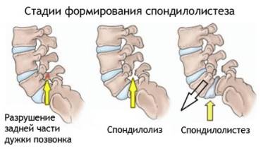 ночью болит спина в области позвоночника