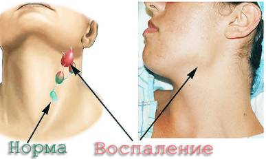 болит спина и бока температура