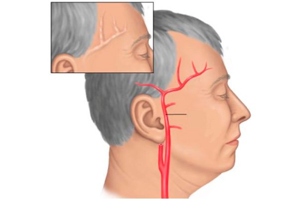 Что делать если сильно болит голова таблетки не помогают