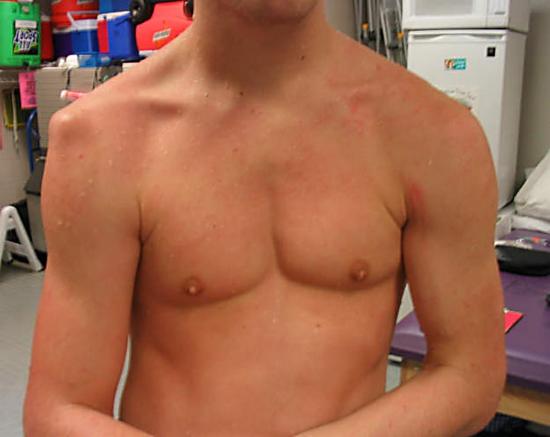 Вывих плечевого сустава