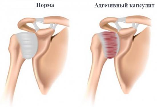 Адгезивный капсулит