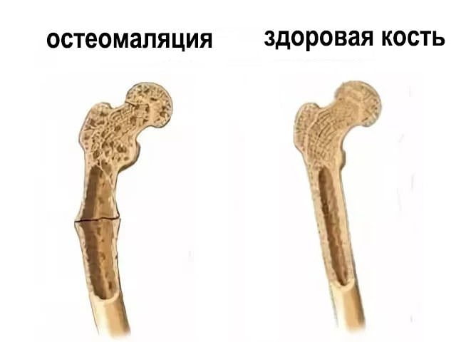 Чем лечить когда болят кости спины