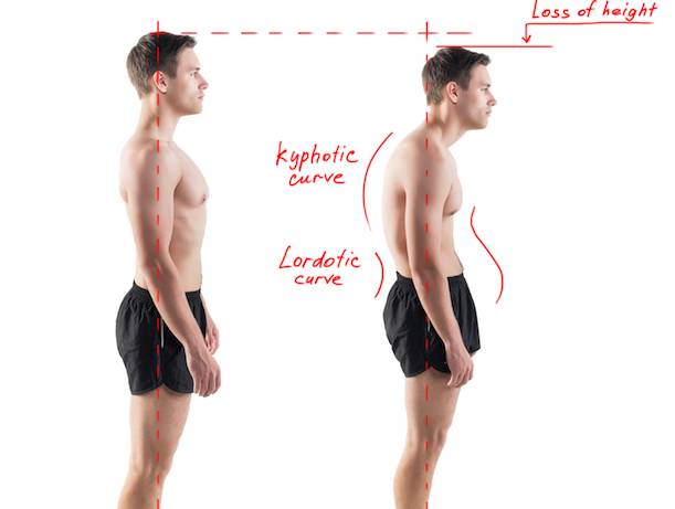 Нарушение осанки