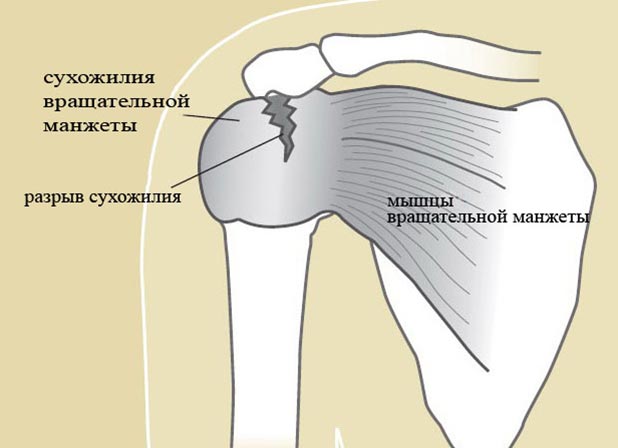 Патология вращательной манжеты плечевого сустава