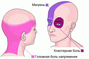 Что делать если сильно болит голова таблетки не помогают